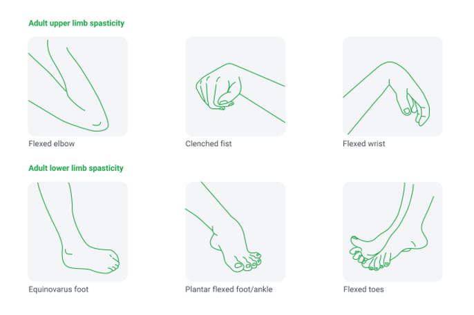 Dysport<sup>®</sup> for Adults with Spasticity