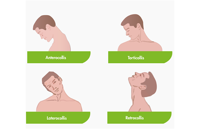 Adult cervical dystonia