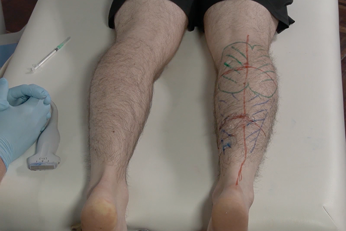 AS US Essentials Injection of the Leg and Foot