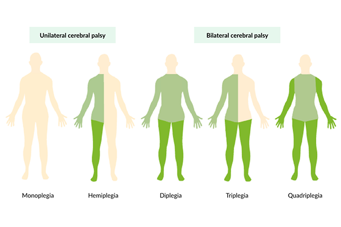 Spasticity in Children